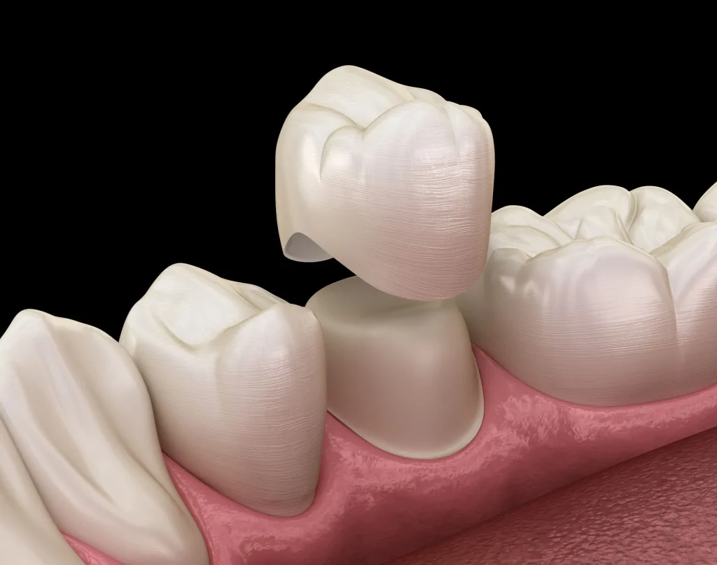 Alcan Family Dental, Same Day Dental Crown Anchorage AK, Family Dental Clinic Anchorage AK, Emergency Dental Care Anchorage AK, Emergency Dental Services Anchorage AK, Dentist Office Anchorage AK, Anchorage Dentures Medicaid, Emergency Dentures Anchorage