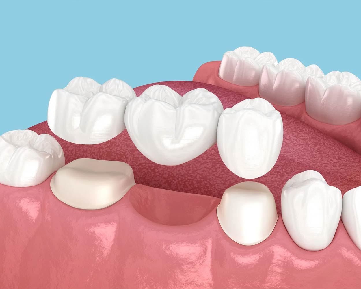 Alcan Family Dental, Same Day Dental Crown Anchorage AK, Family Dental Clinic Anchorage AK, Emergency Dental Care Anchorage AK, Emergency Dental Services Anchorage AK, Dentist Office Anchorage AK, Anchorage Dentures Medicaid, Emergency Dentures Anchorage