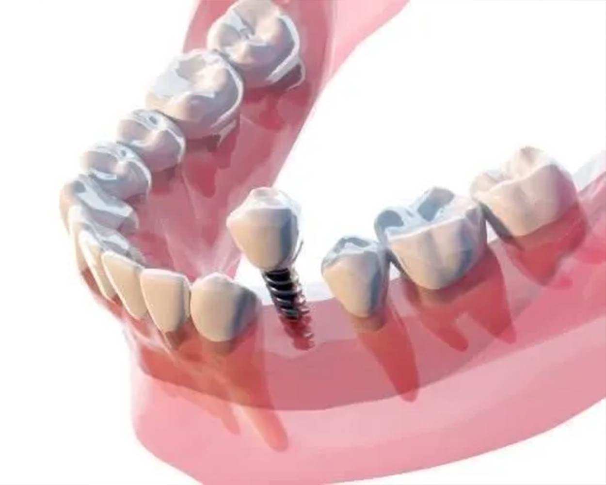 Alcan Family Dental, Same Day Dental Crown Anchorage AK, Family Dental Clinic Anchorage AK, Emergency Dental Care Anchorage AK, Emergency Dental Services Anchorage AK, Dentist Office Anchorage AK, Anchorage Dentures Medicaid, Emergency Dentures Anchorage