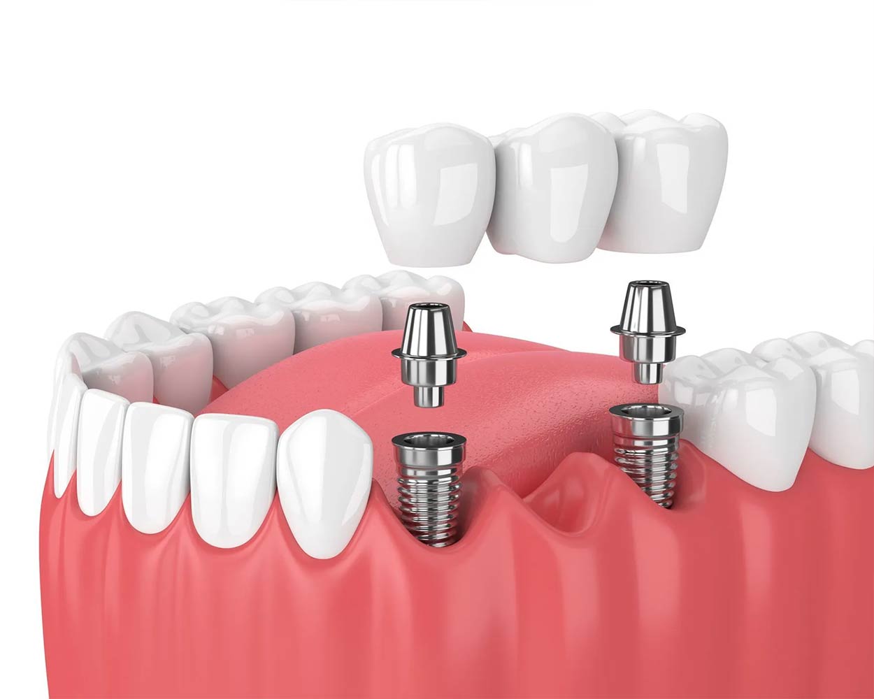 Alcan Family Dental, Same Day Dental Crown Anchorage AK, Family Dental Clinic Anchorage AK, Emergency Dental Care Anchorage AK, Emergency Dental Services Anchorage AK, Dentist Office Anchorage AK, Anchorage Dentures Medicaid, Emergency Dentures Anchorage