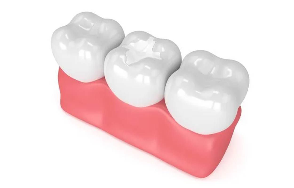 Dental Sealants Alcan Family Dental, Same Day Dental Crown Anchorage AK, Family Dental Clinic Anchorage AK, Emergency Dental Care Anchorage AK, Emergency Dental Services Anchorage AK, Dentist Office Anchorage AK, Anchorage Dentures Medicaid, Emergency Dentures Anchorage
