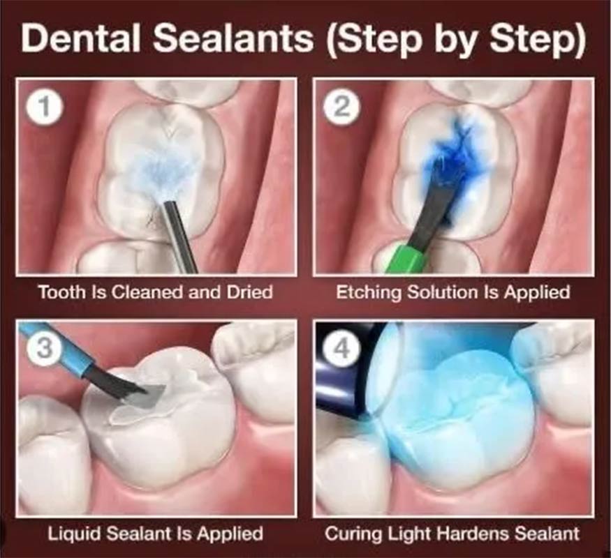 Dental Sealants Alcan Family Dental, Same Day Dental Crown Anchorage AK, Family Dental Clinic Anchorage AK, Emergency Dental Care Anchorage AK, Emergency Dental Services Anchorage AK, Dentist Office Anchorage AK, Anchorage Dentures Medicaid, Emergency Dentures Anchorage